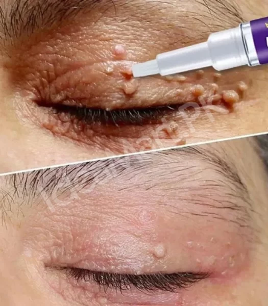 skin-tag-mole-remover-pen-remove-warts-pimples-black-dots-safely-for-women-product-image