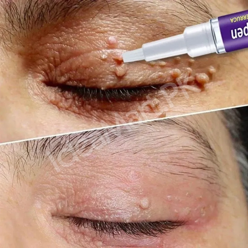 skin-tag-mole-remover-pen-remove-warts-pimples-black-dots-safely-for-women-product-image