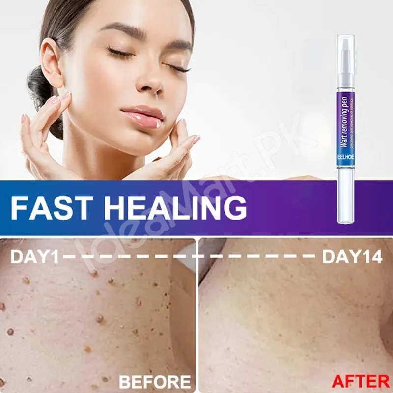 skin-tag-mole-remover-pen-remove-warts-pimples-black-dots-safely-for-women-product-image