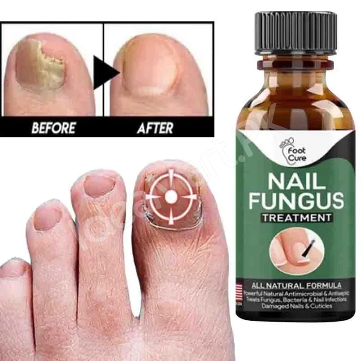 fast-nail-fungal-treatments-nail-repair-essences-serum-care-treatments-foot-nail-fungus-removal-gel-paronychia-product-image
