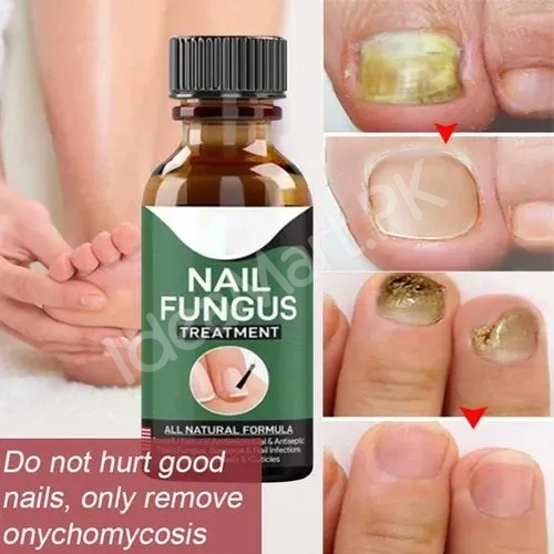 fast-nail-fungal-treatments-nail-repair-essences-serum-care-treatments-foot-nail-fungus-removal-gel-paronychia-product-image