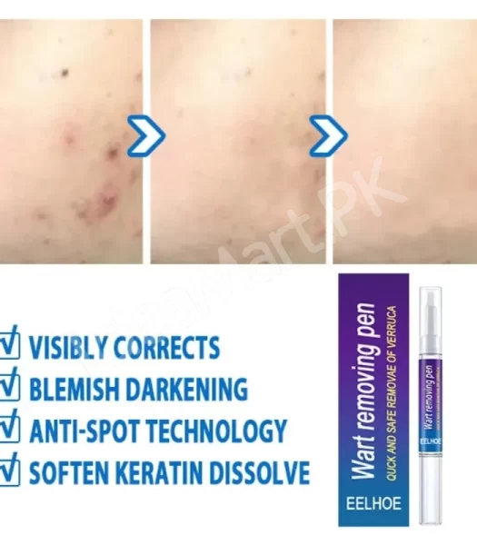 skin-tag-mole-remover-pen-remove-warts-pimples-black-dots-safely-for-women-product-image