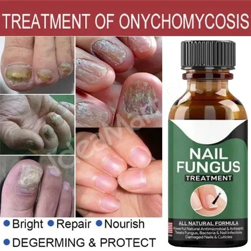 fast-nail-fungal-treatments-nail-repair-essences-serum-care-treatments-foot-nail-fungus-removal-gel-paronychia-product-image